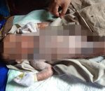 Bayi di Banyuasin Diduga Alami Gizi Buruk, Kulit Melepuh Disekujur Tubuh